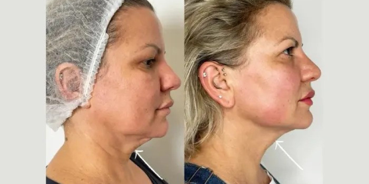 How Endolift Treatments in Dubai Helps with Double Chin Reduction