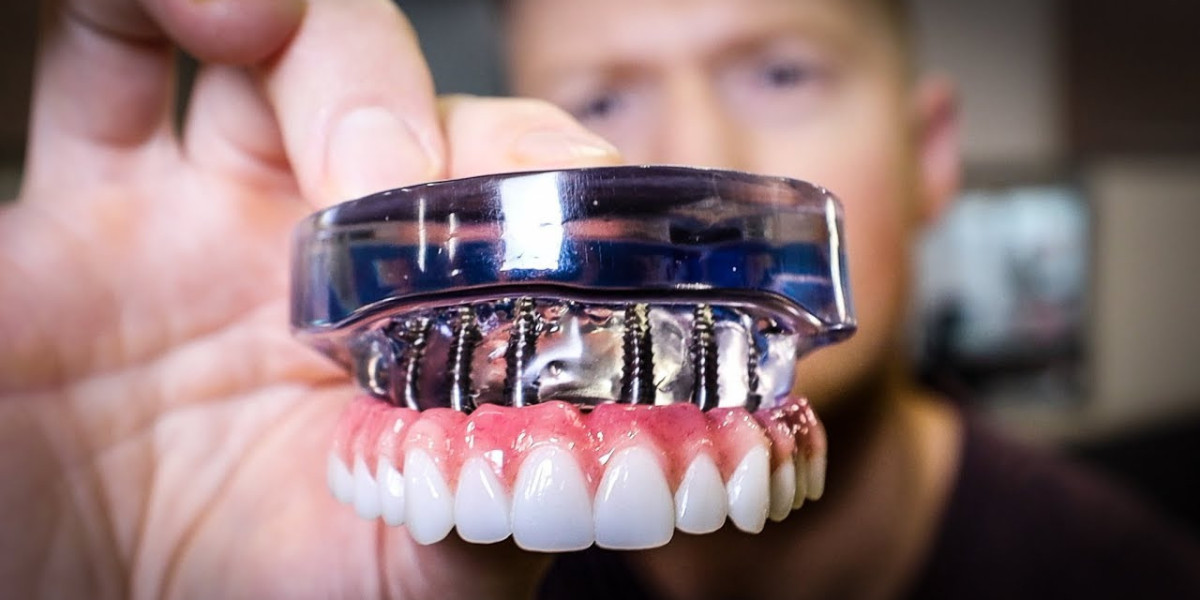 Full Mouth Dental Implants Cost in Dubai and Treatment Benefits