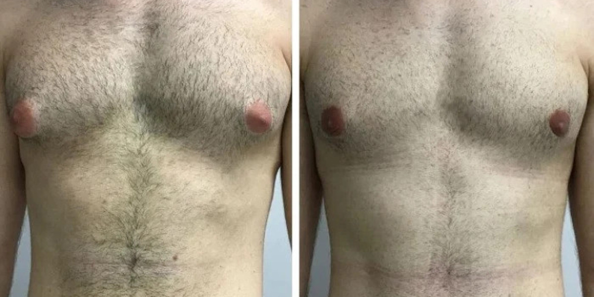 How the Best Doctors in Dubai Ensure Safe Anesthesia During Gynecomastia Surgery