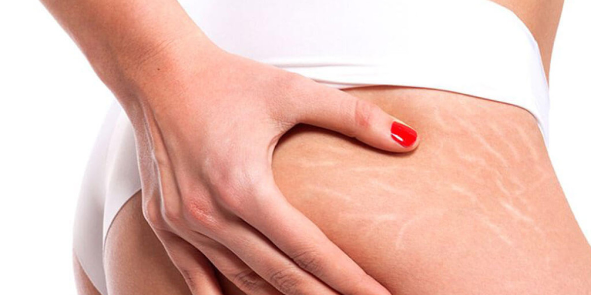 Are Stretch Mark Removal Treatments Safe for All Skin Types?