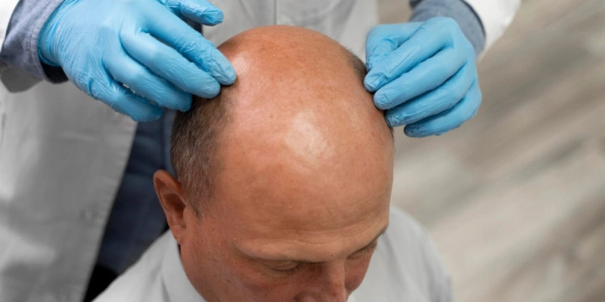 Hair Transplant Dubai That Enhances Hair Texture, Shape, and Overall Presence