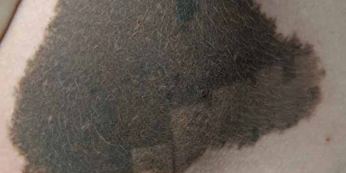 Birthmark Removal in Dubai: What Results Can You Expect?