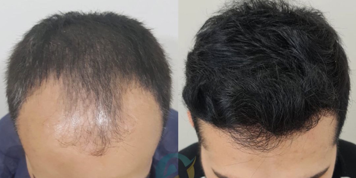 Achieve a Fuller Head of Hair with Hair Transplant in Islamabad