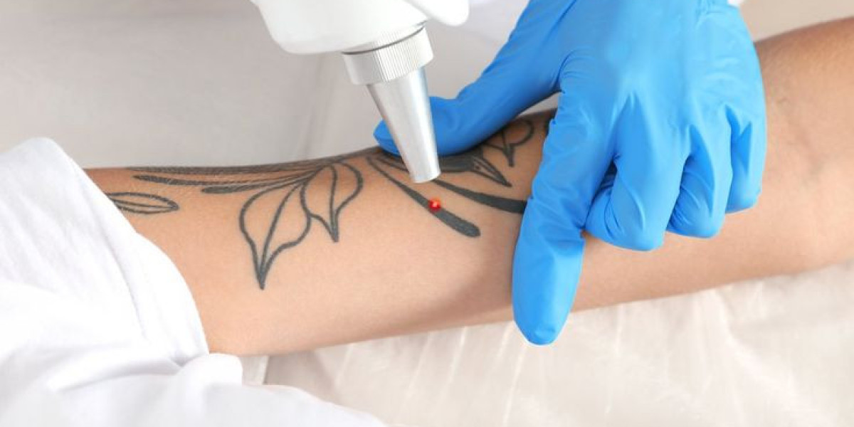 Tattoo Removal for Dark Skin Tones: Safety and Results in Riyadh