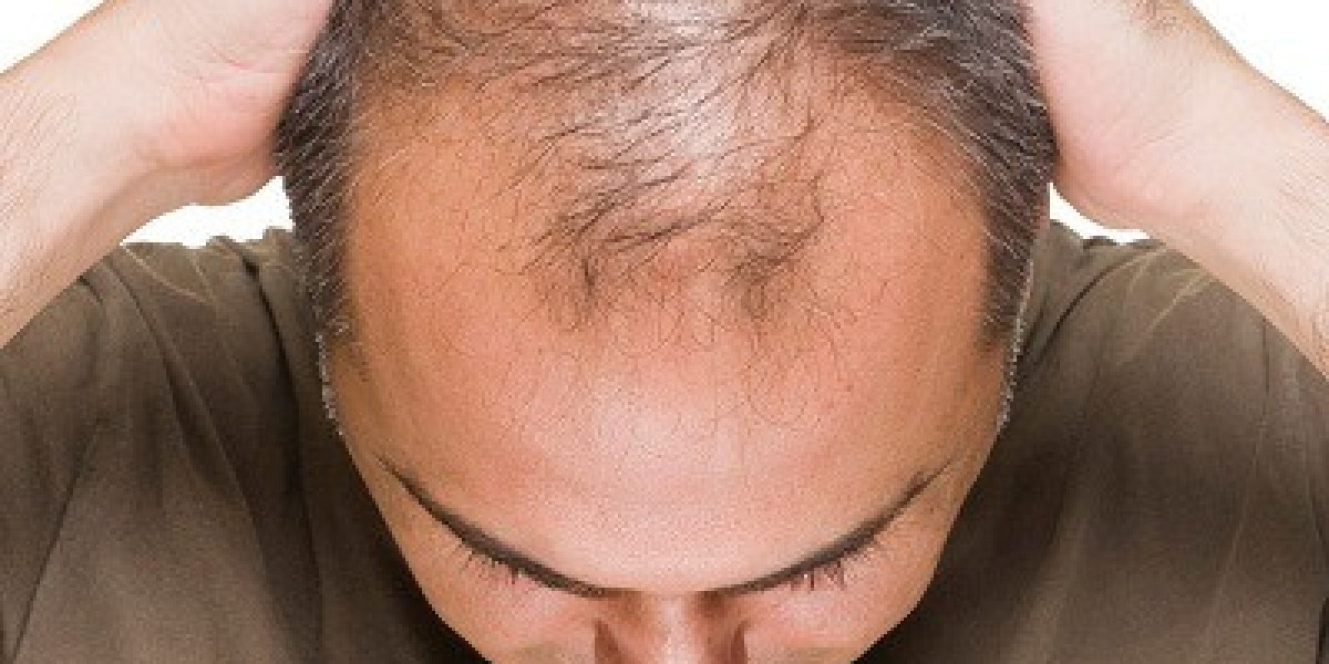 Experience Rapid Hair Regrowth with Finasteride for Hair Loss