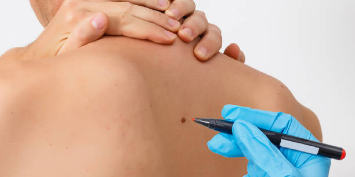 Warts Removal in Dubai: Effective Solutions for Clear Skin