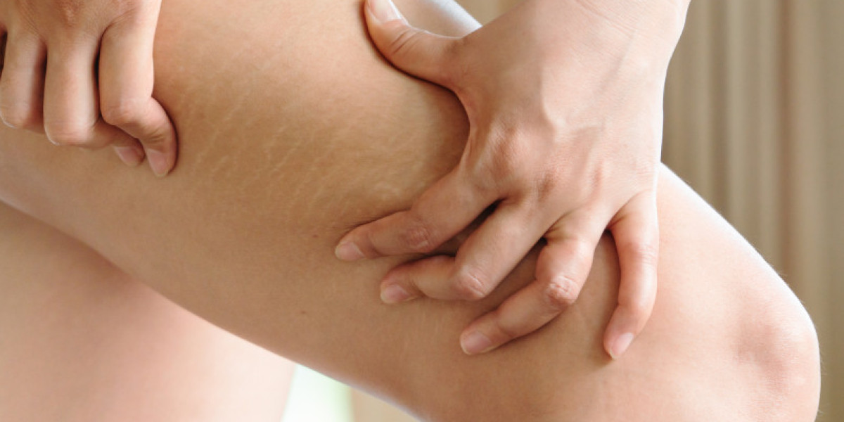 Are Stretch Mark Removal Treatments Safe for All Skin Types?