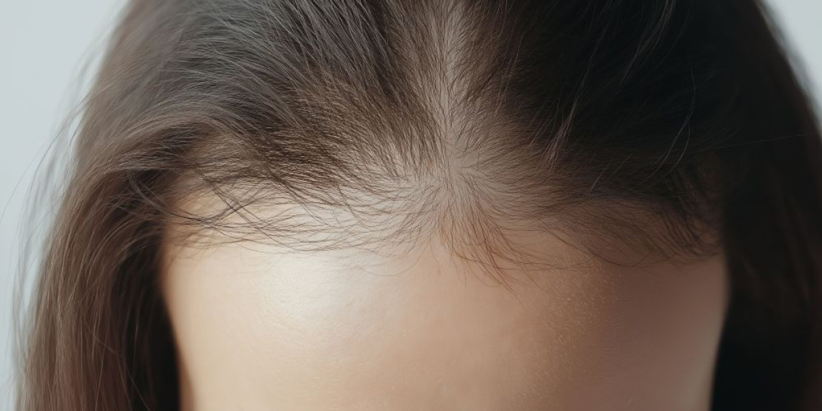 Hair Loss Treatment for Stress-Induced Hair Fall