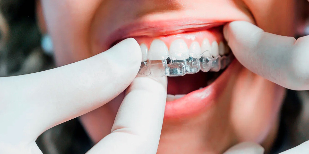 How Dental Aligners in Dubai Transform Your Smile