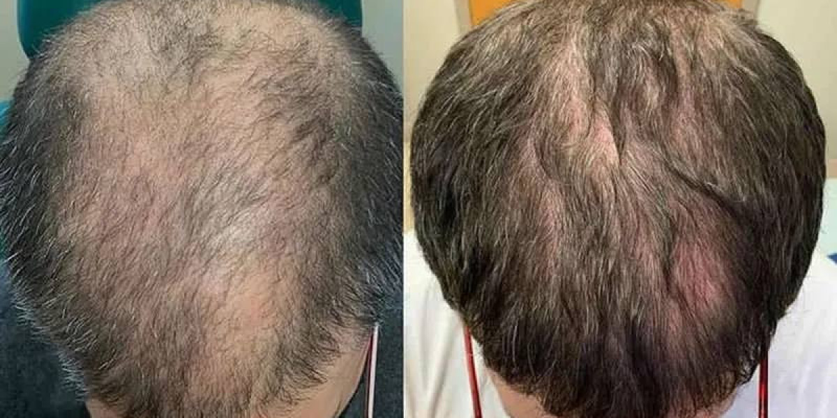 Post-Treatment Success: Maximizing Your Exosome Hair Results in Riyadh