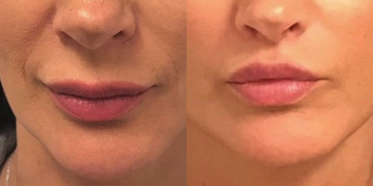 Why a Lip Lift Is a Preferred Procedure for Lip Enhancement