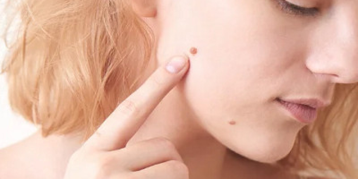 Is Skin Tag Removal Considered a Safe Treatment?