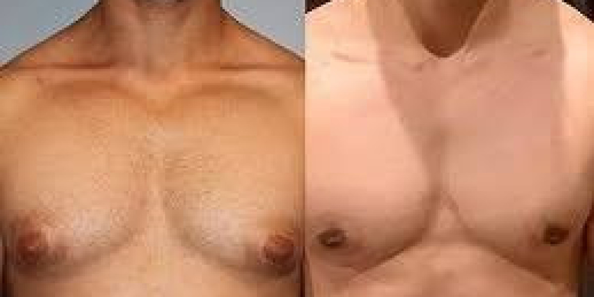 Risks and Safety Measures for Gynecomastia Surgery in Dubai