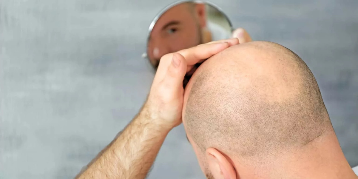 Can Hair Transplant in Dubai be done for scars?