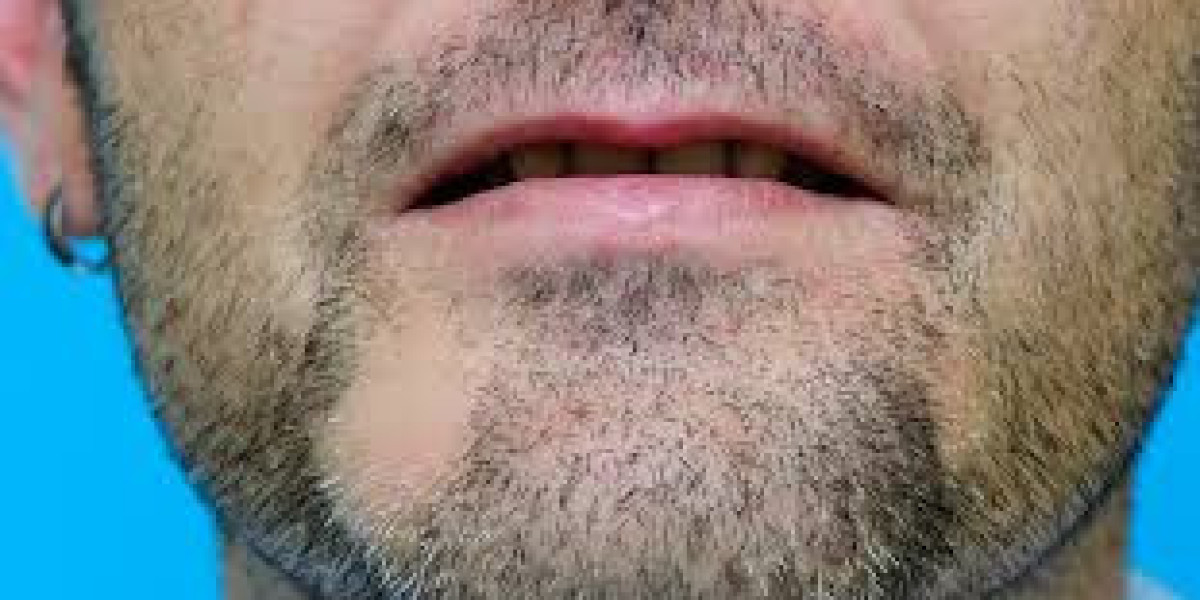 Beard Hair Transplant for Cheek Beard Gaps