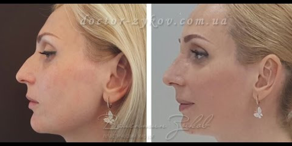 Natural-Looking Results: The Evolution of Rhinoplasty Techniques