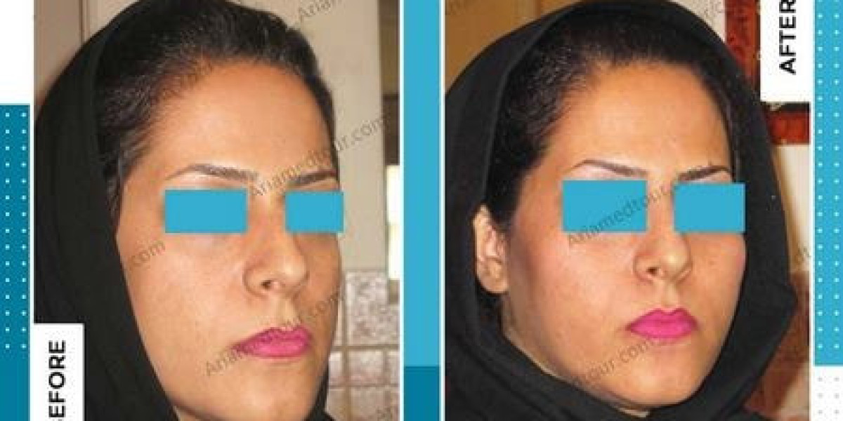 The Art of Facial Sculpting: Cheek Augmentation Trends in Riyadh