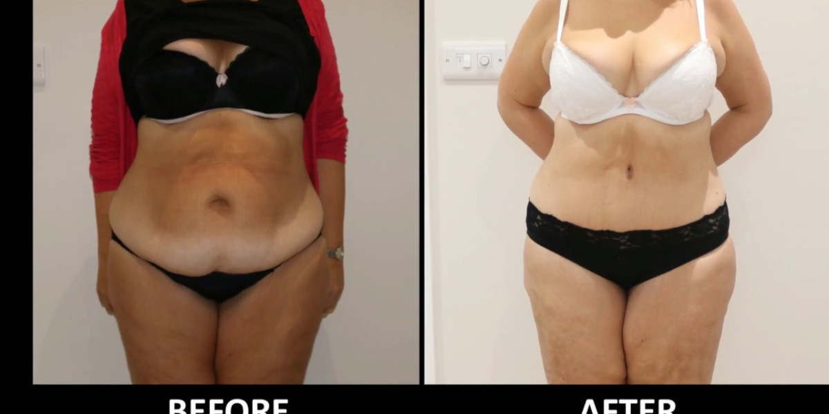 Modern Abdominoplasty Techniques Available in Riyadh