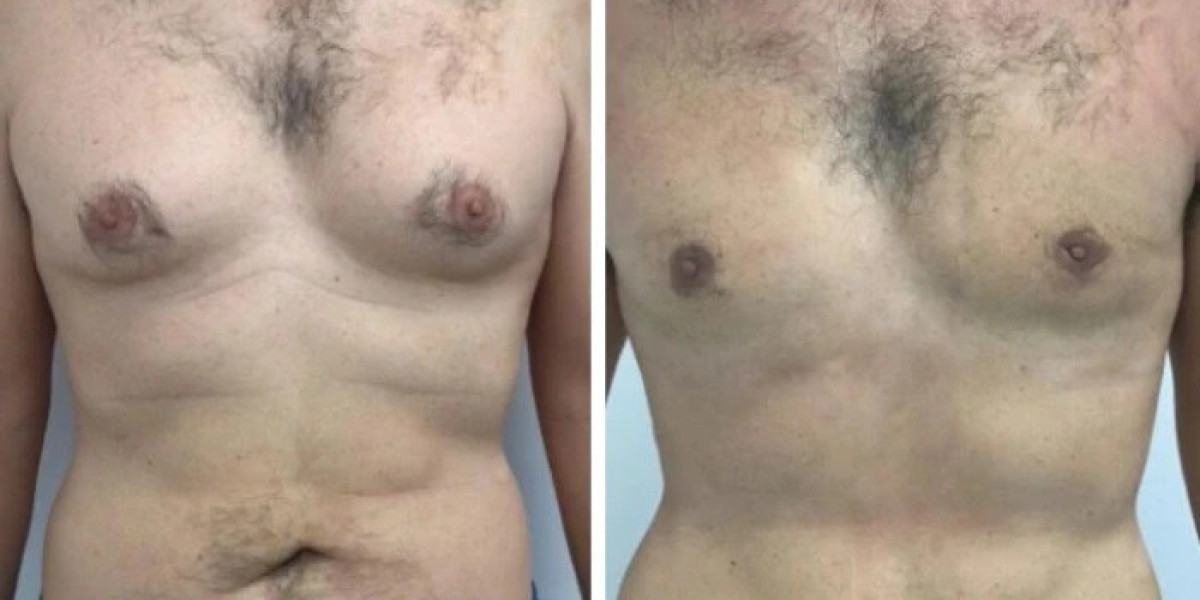 How the Best Gynecomastia Surgeons in dubai Achieve Minimal Scarring