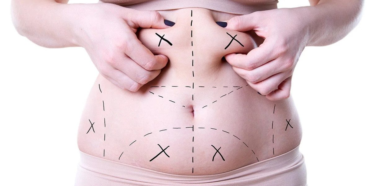 How Long Does Fat Transfer Surgery Take to Complete?