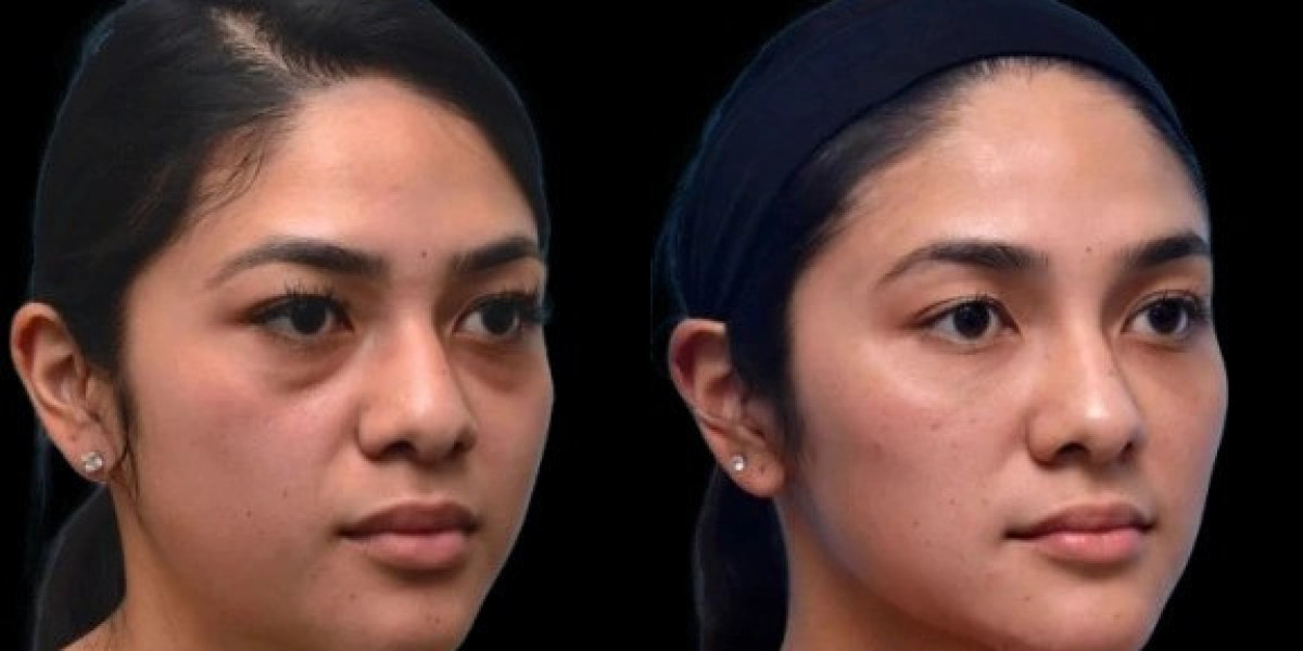 Comparing Treatments by the Best Plastic Surgeon in Dubai for Dark Circles