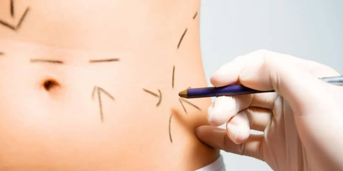 Long Term Results of 360 Degree Abdominal Contouring