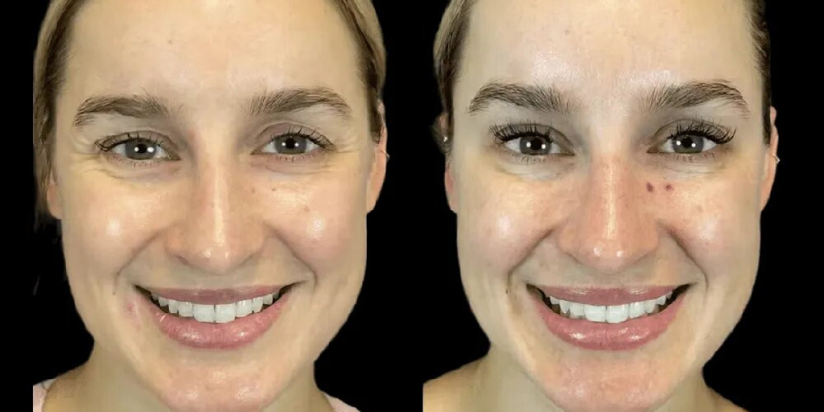 Why Celebrities Choose Best Doctors in Dubai for Botox Treatments