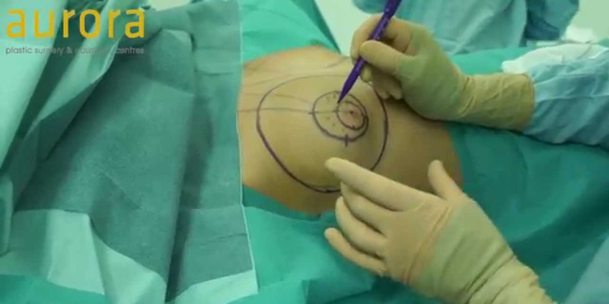 أهم الأسئلة حول تكبير الثدي بتقنية AFT