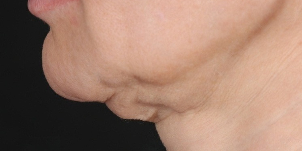Can Neck Lift Surgery Improve a Double Chin?