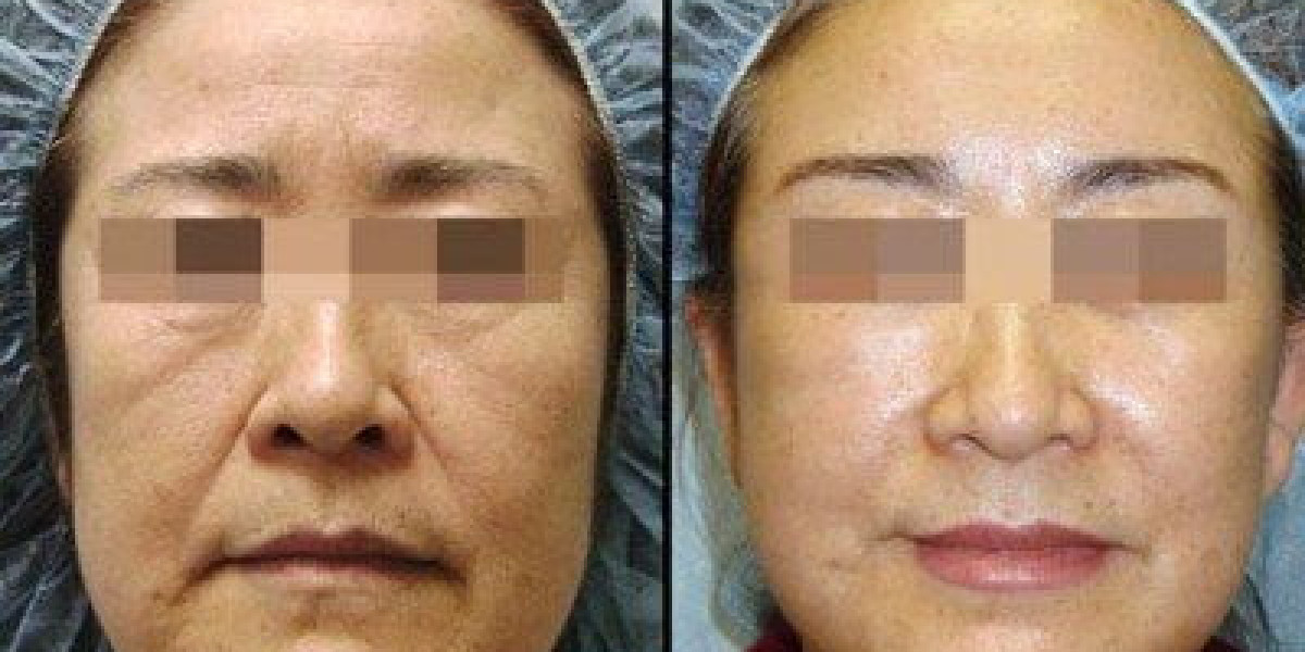 The Complete Guide to Recovery After a Stem Cell Facelift in Riyadh