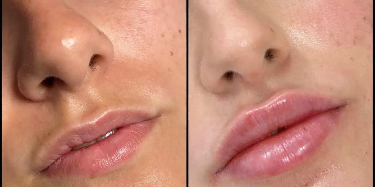 Best Aesthetic Clinic in Dubai for Fillers Natural Beauty Through Science