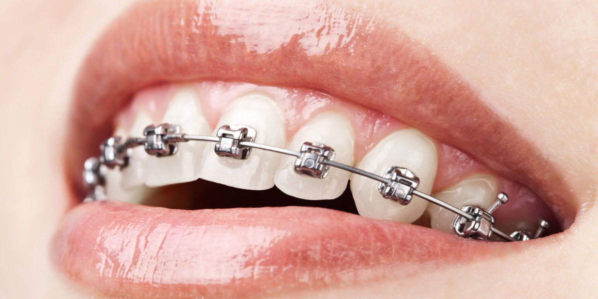 Best Dental Braces in Dubai: Expert Guide for a Perfect Smile