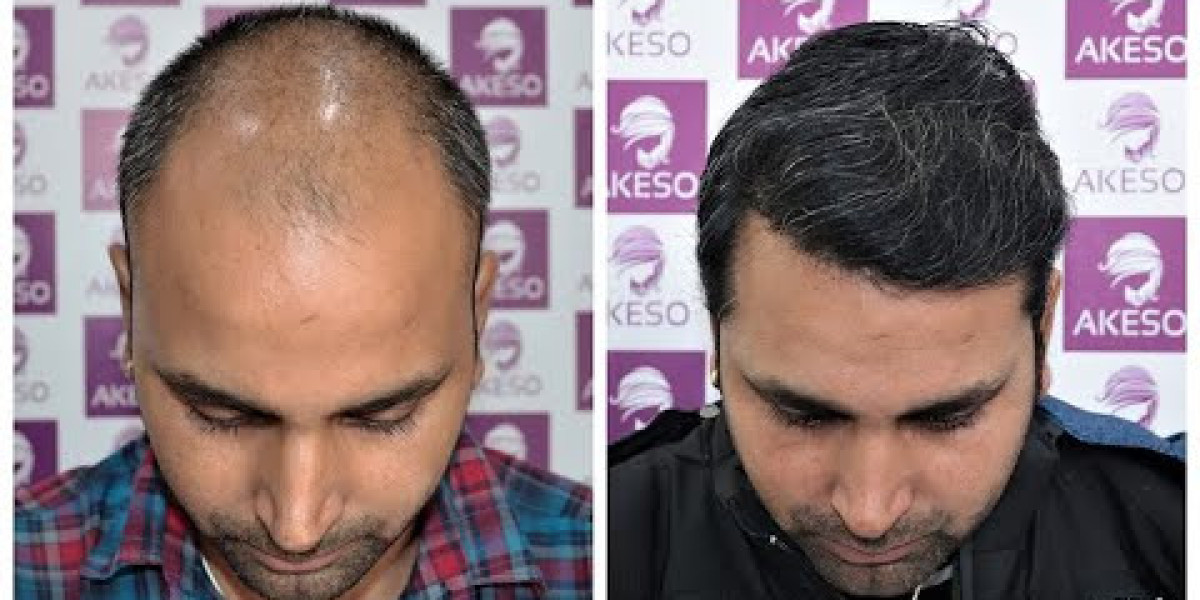 How Hair Transplant Cost Reflects Quality?