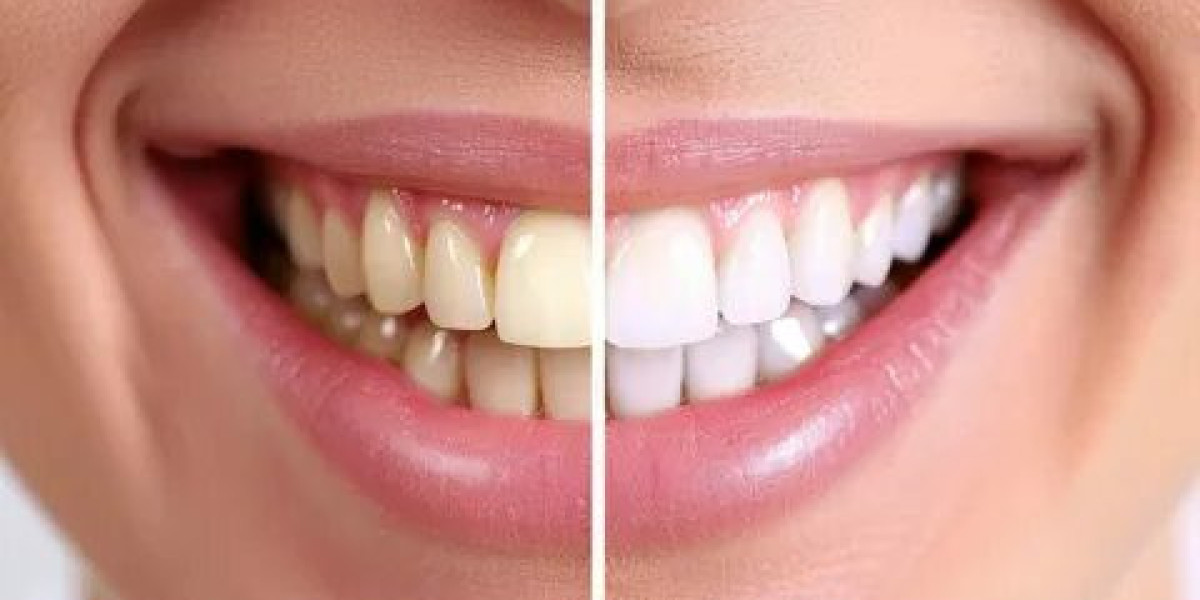 Best Teeth Whitening Solutions for Stubborn Yellow Teeth