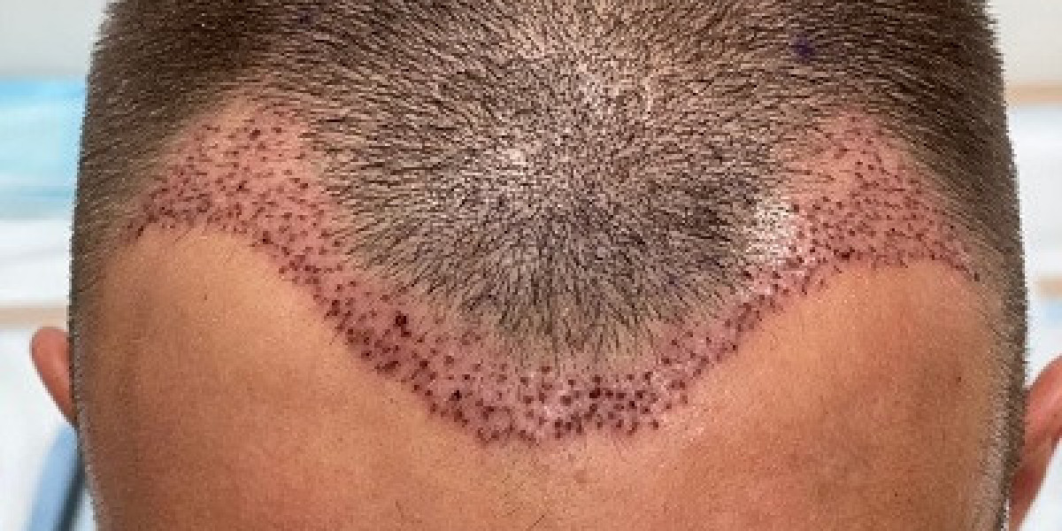 Your Guide to Customized Hair Restoration Plans in Dubai