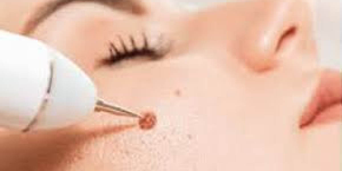 Beyond the Surface: Navigating Safe and Scarless Mole Removal in Lahore