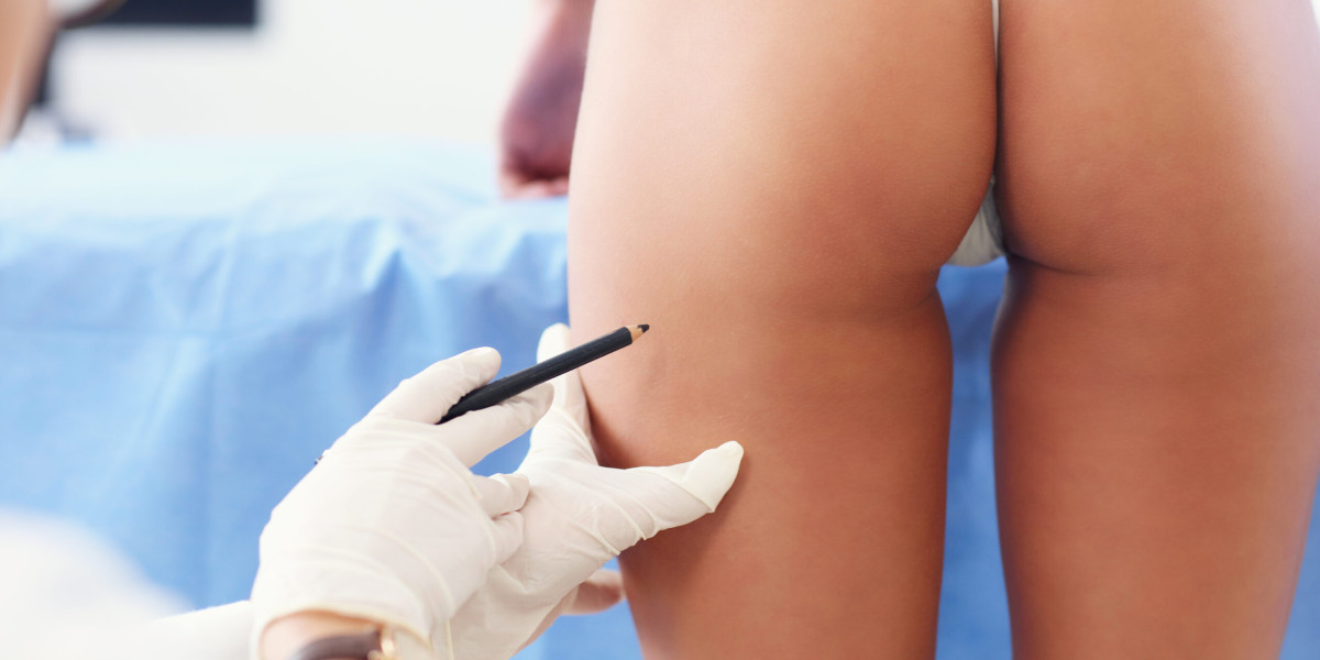 Is Hyacorp Better for Body Contouring Than Other Fillers?