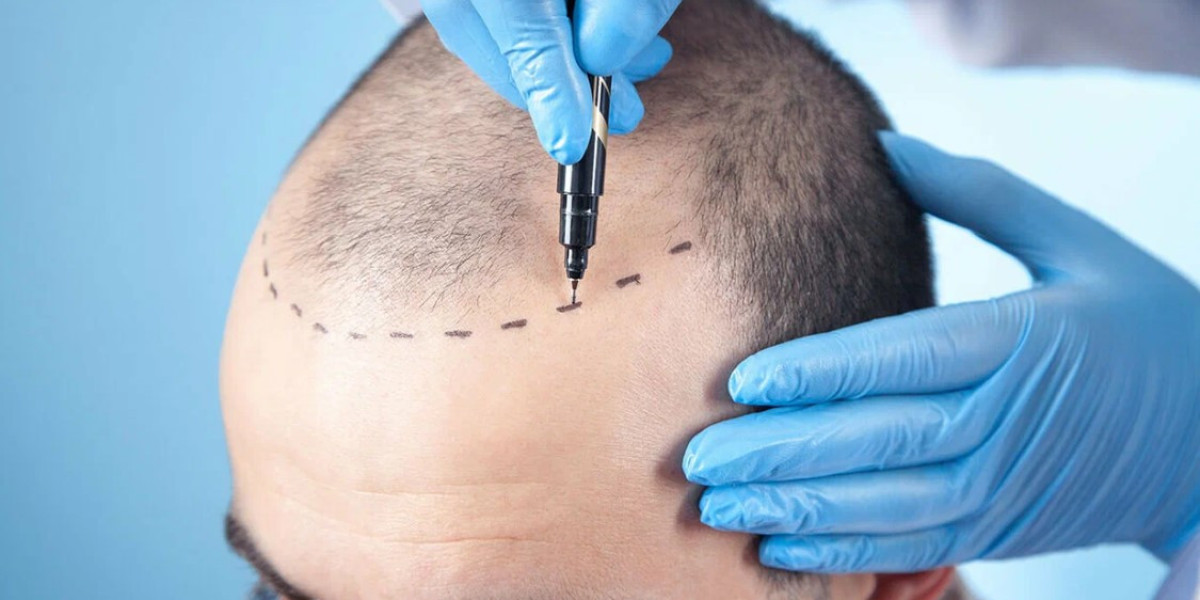 Role of nutrition in supporting hair transplant in Buraydah