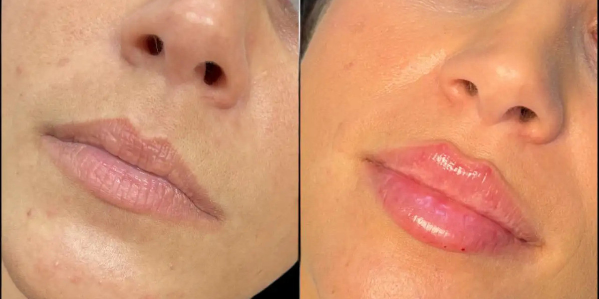 Best Aesthetic Clinic in Dubai for Dermal Fillers Trusted Professionals