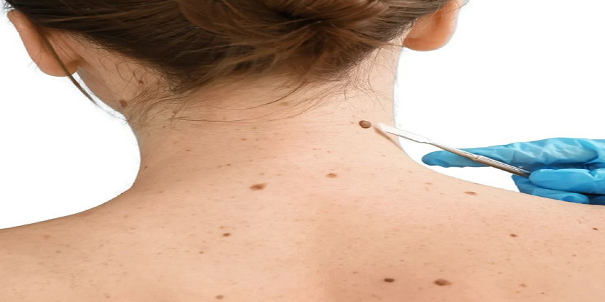 Mole Removal in Dubai: Precision Treatments for Every Patient