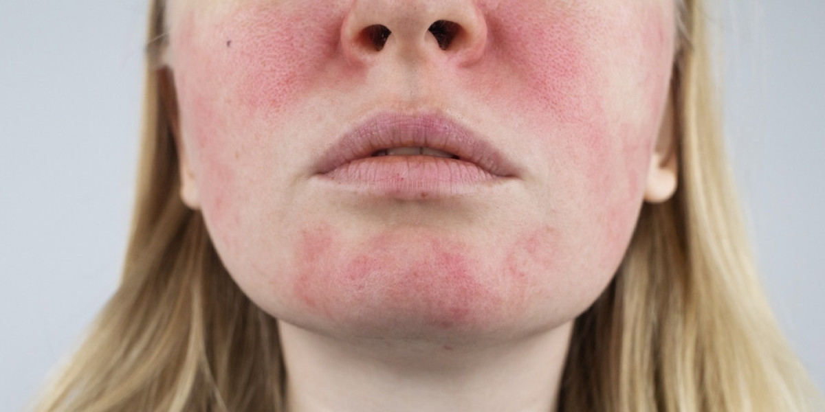 How to Tell Nummular Eczema Apart from Ringworm: Diagnosis Guide