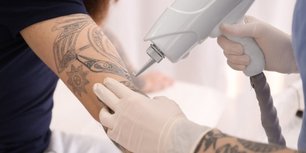 Common myths about tattoo removal in Riyadh