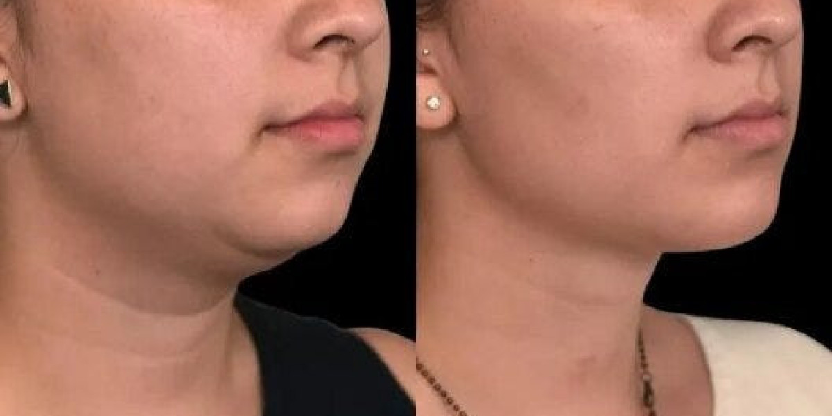 Radiofrequency Treatments for a Firmer Jawline in Riyadh