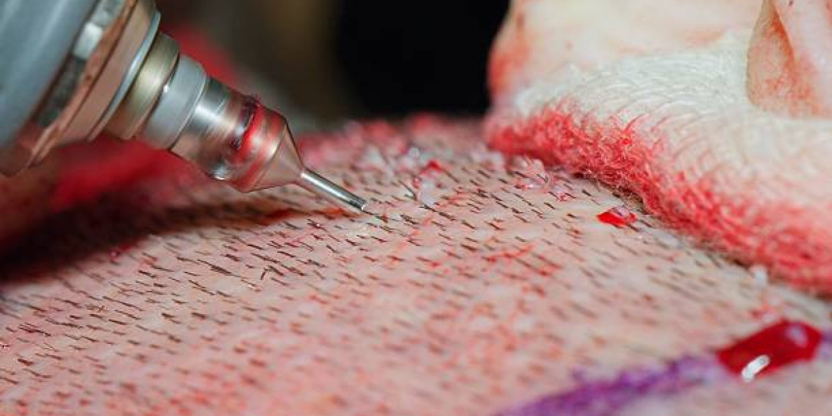 FUE Hair Transplant in Islamabad – Permanent Hair Restoration Solution