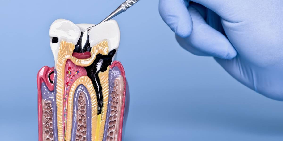 Root Canal Treatment for Cracked or Damaged Teeth