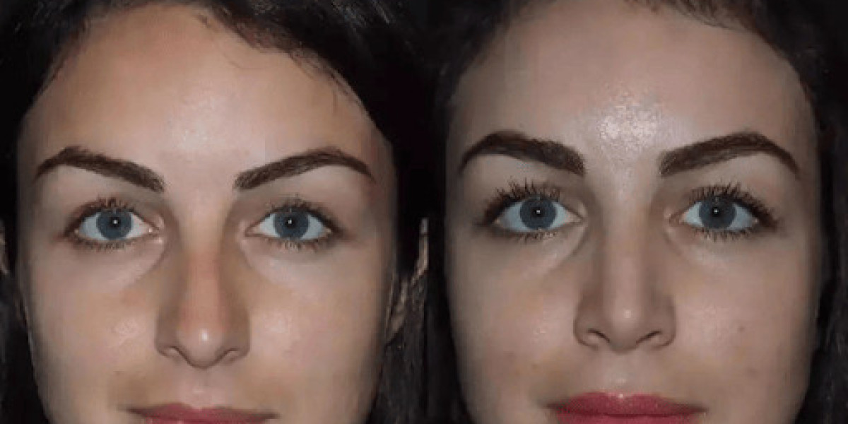 Best Doctors in Dubai for Rhinoplasty with International Standards