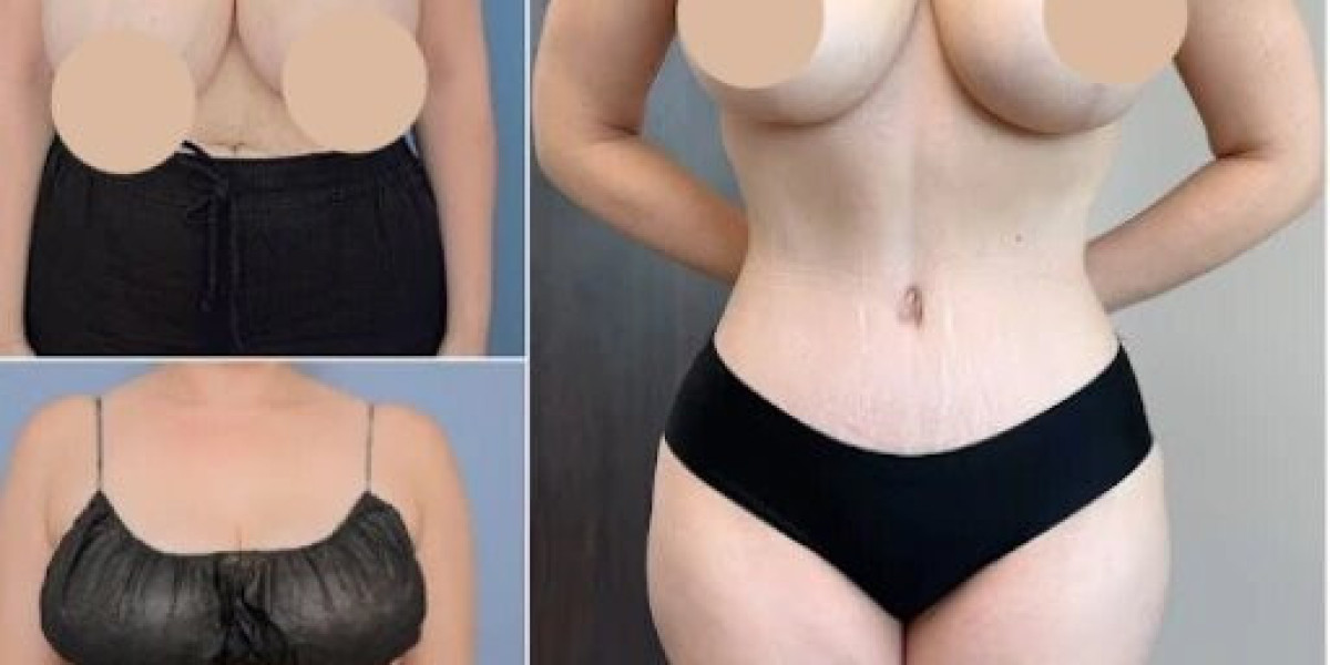 Transform Your Figure with the Best Tummy Tuck Surgeon in Dubai