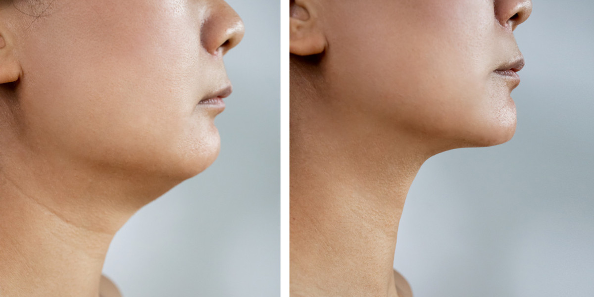 Customizing Your Look: Tailoring Chin Reduction to Your Unique Features
