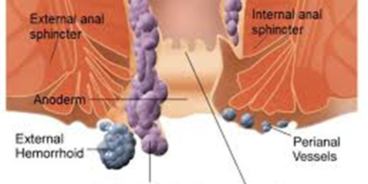 Modern Treatment of Hemorrhoids Bleeding with Expert Medical Support