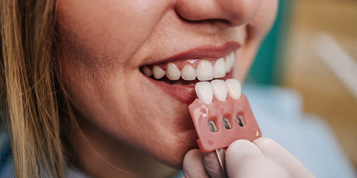 Before & After Results, Smile Transformation Explained Dental Veneers in Pakistan: